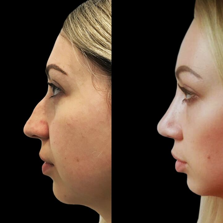 Rinoplastie