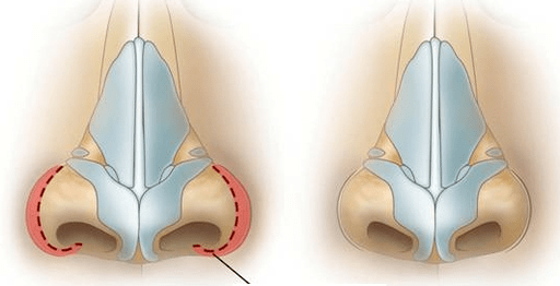 Réduction des narines