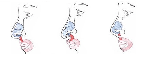 Troncature d'une partie du muscle nasal