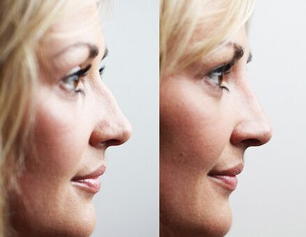 Avant et après rhinoplastie avec fillers
