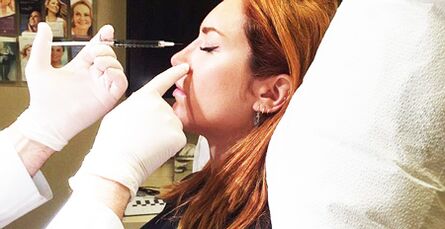 Procédure de rhinoplastie utilisant des fillers