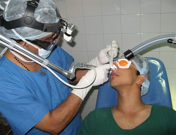 correction du septum à l'aide d'un scalpel laser