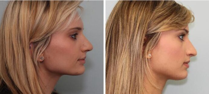 Résultats de rhinoplastie avant et après