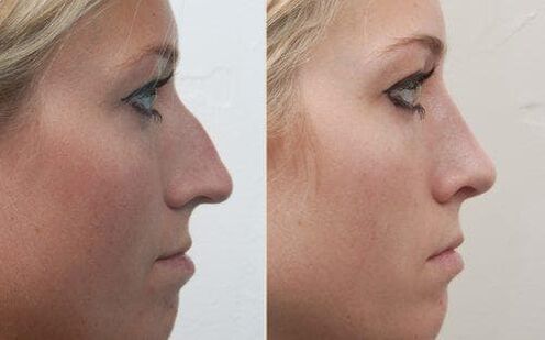 Avant et après une rhinoplastie non chirurgicale