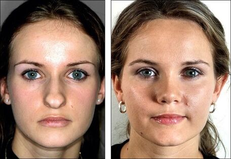 avant et après la rhinoplastie