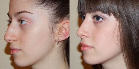 photos avant et après rhinoplastie nasale