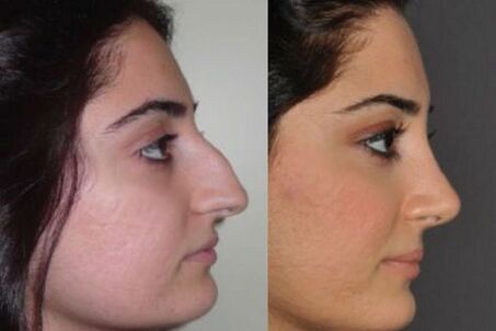 photos avant et après rhinoplastie