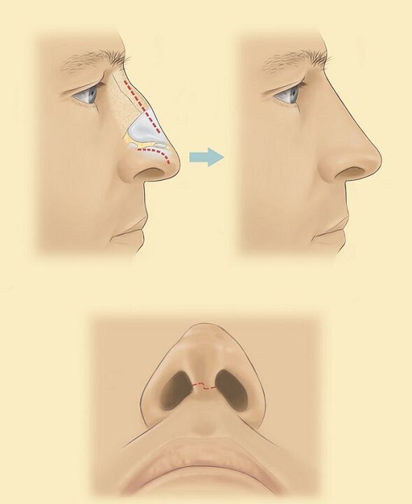 schéma de rhinoplastie du nez