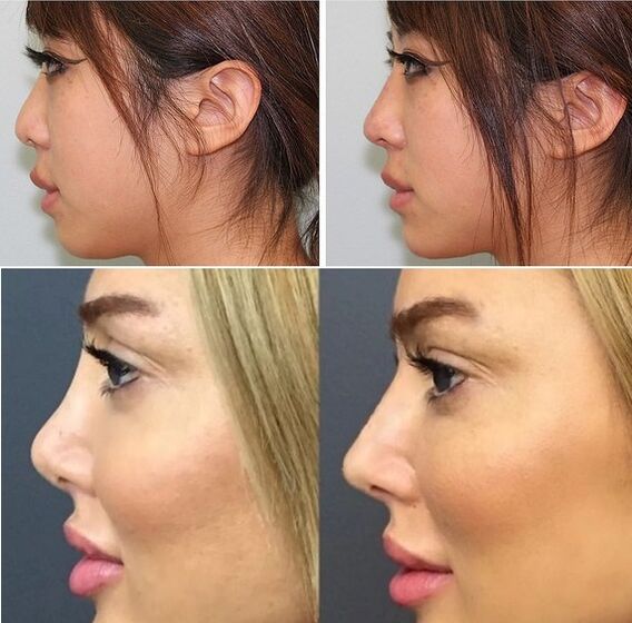 photos avant et après rhinoplastie non chirurgicale