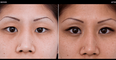 avant et après chirurgie oculaire