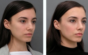 La jeune fille avant et après la rhinoplastie du nez